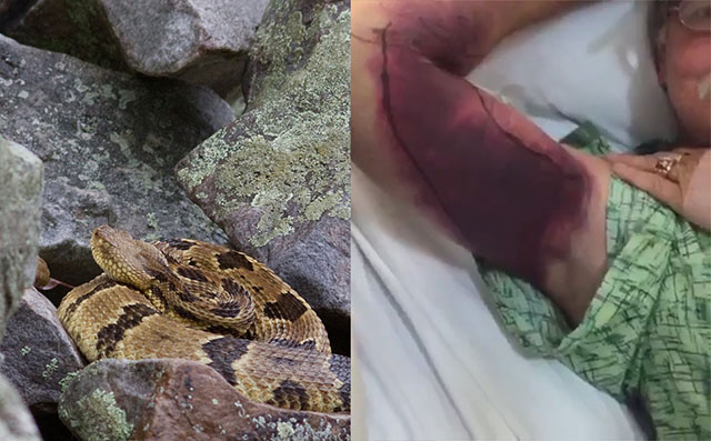 bittenrattlesnake