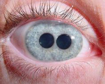 double pupil
