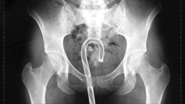 RECTUM