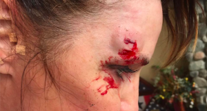 Sarah-Palin-shows-a-head-injury-she-received-while-rock-running-via-Facebook-300x161