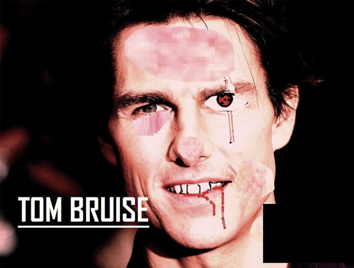 tom bruise