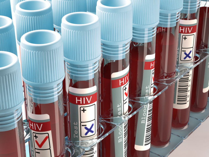 hiv