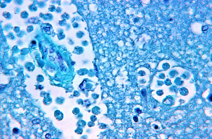 Magnified 500x, this photomicrograph of a brain tissue specimen depicts the cytoarchitectural changes associated with a free-living, Naegleria fowleri, amebic infection. When free-living amebae infect the brain or spinal cord, the condition is known as pr