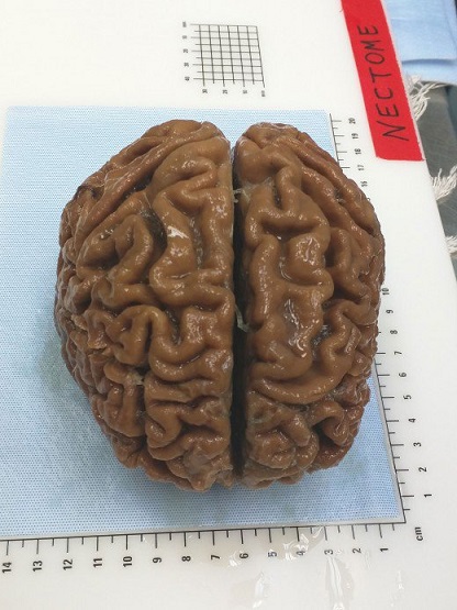 preserved-brain