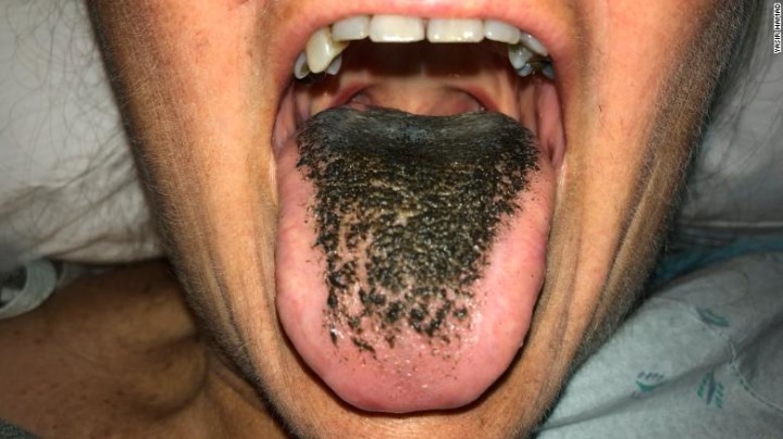 180905123544-01-black-hairy-tongue-exlarge-169